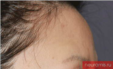 Отзывы Нейрамис до процедуры женщина 43 года возраст зона филлера лоб