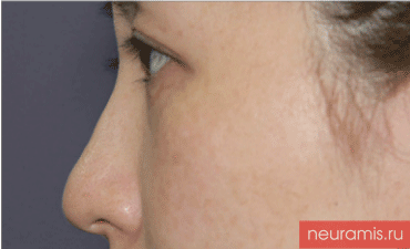 Отзывы Нейрамис до процедуры женщина 32 года возраст зона филлера нос
