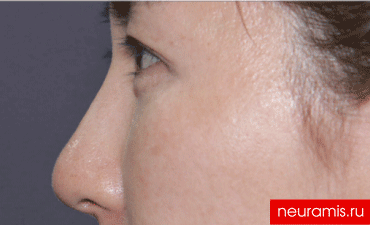 Отзывы Нейрамис после процедуры женщина 32 года возраст зона филлера нос