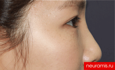 Отзывы Нейрамис после процедуры женщина 29 лет возраст зона филлера нос