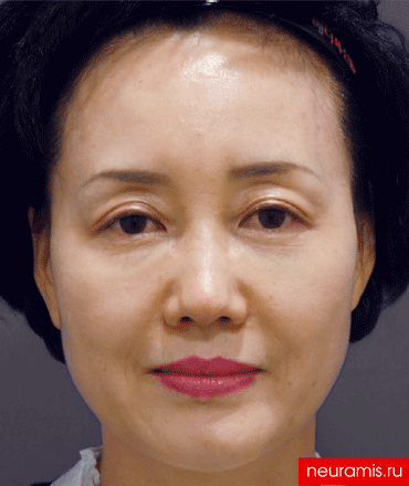 Результаты Нейрамис после процедуры женщина 52 года возраст зона филлера нос лоб носогубная складка скулы