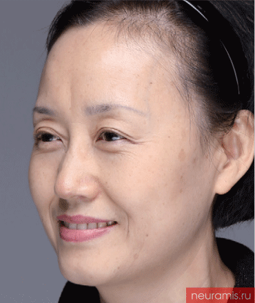 Результаты Нейрамис до процедуры женщина 52 года возраст зона филлера нос лоб носогубная складка скулы