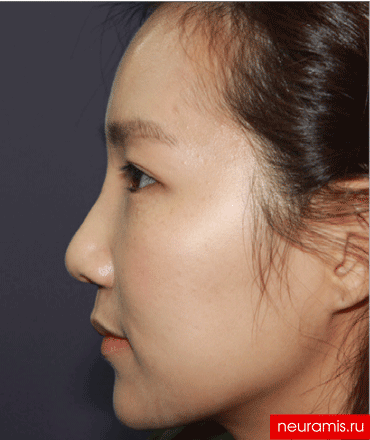 Отзывы Нейрамис после процедуры женщина 29 лет возраст зона филлера нос носогубная складка скулы подбородок 2